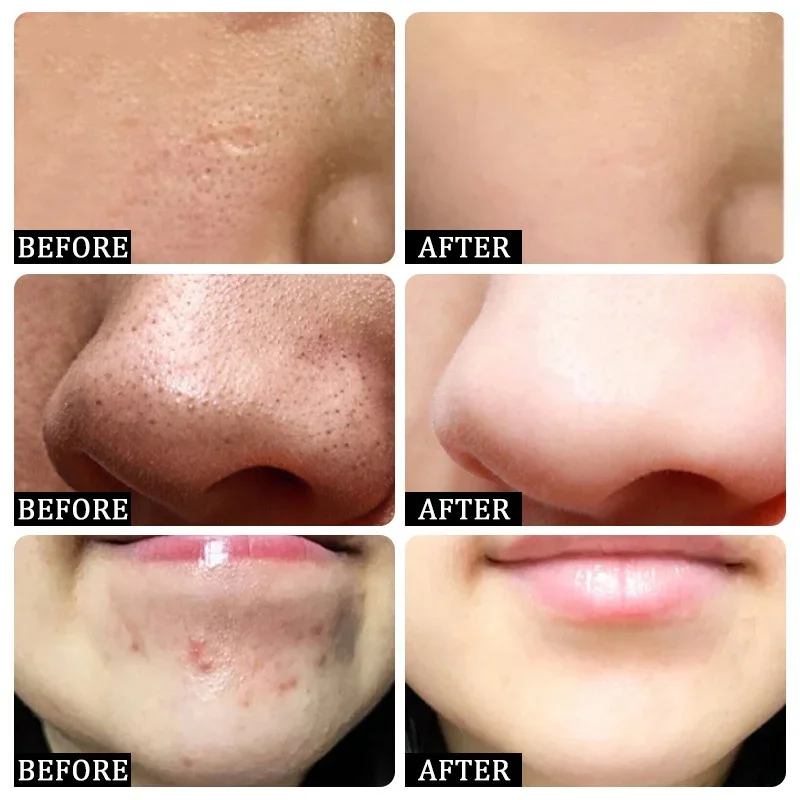 Salicylzuur Porie Clearing Cre - Korean Skincare Routine recensie en prijs
