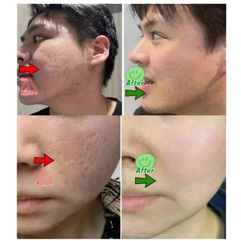 Salicylzuur Porie Clearing Cre - Korean Skincare Routine recensie en prijs